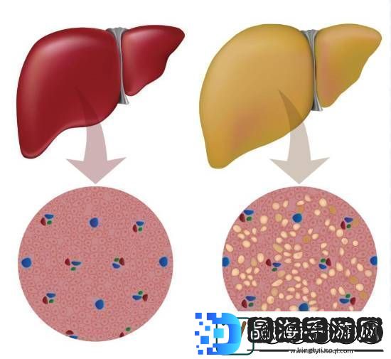 大学生月瘦20斤却患上脂肪肝